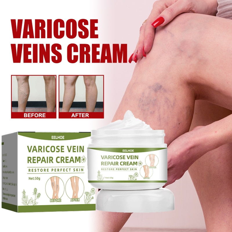 Varicose Veins Ointment Through Vein Leg Relief Cream Relieve