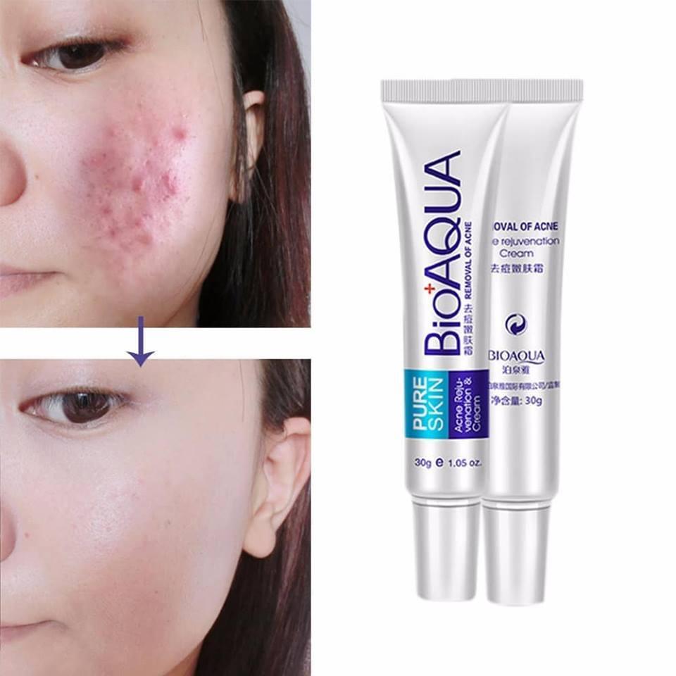 bioaqua anti acne cream