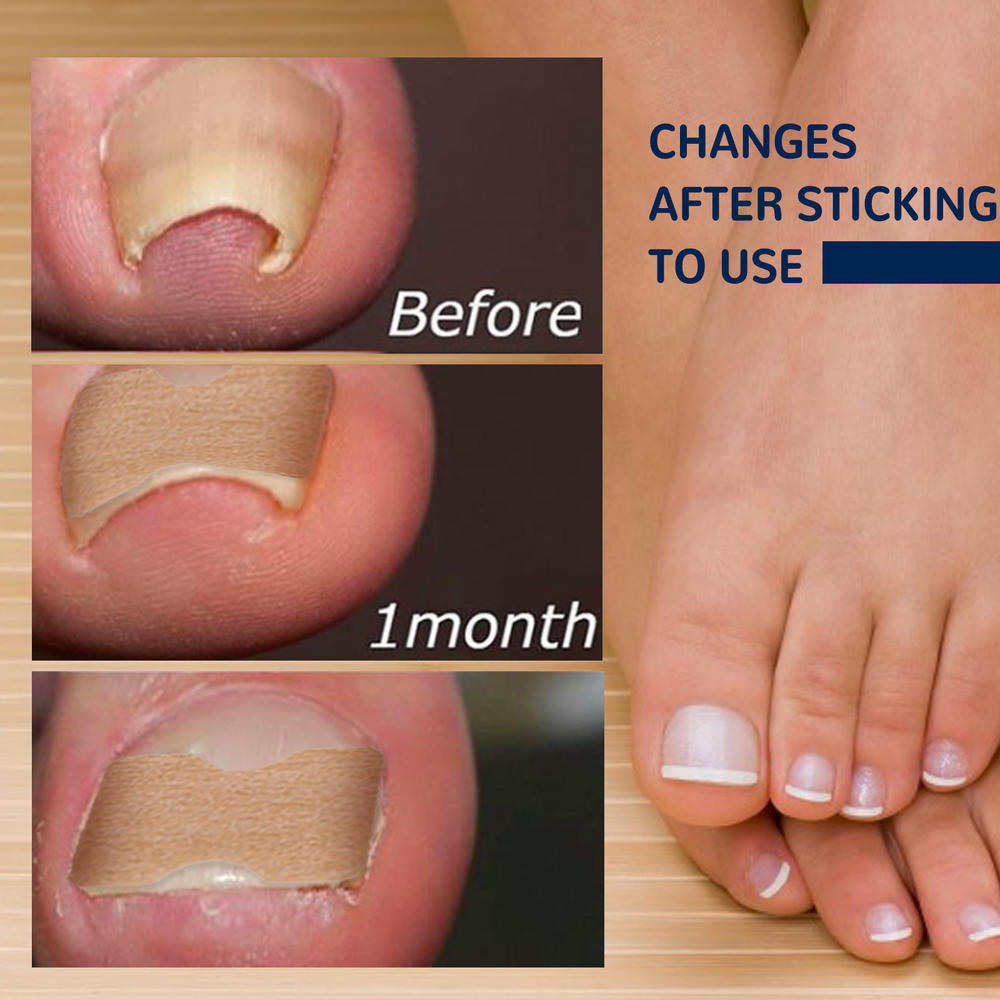Ingrown Toenail Correction Patch Glue-Free Ingrown Toenail Corrector Strip Painless Pedicure Toenail Corrector Patch With Nail Correction Tool. 
