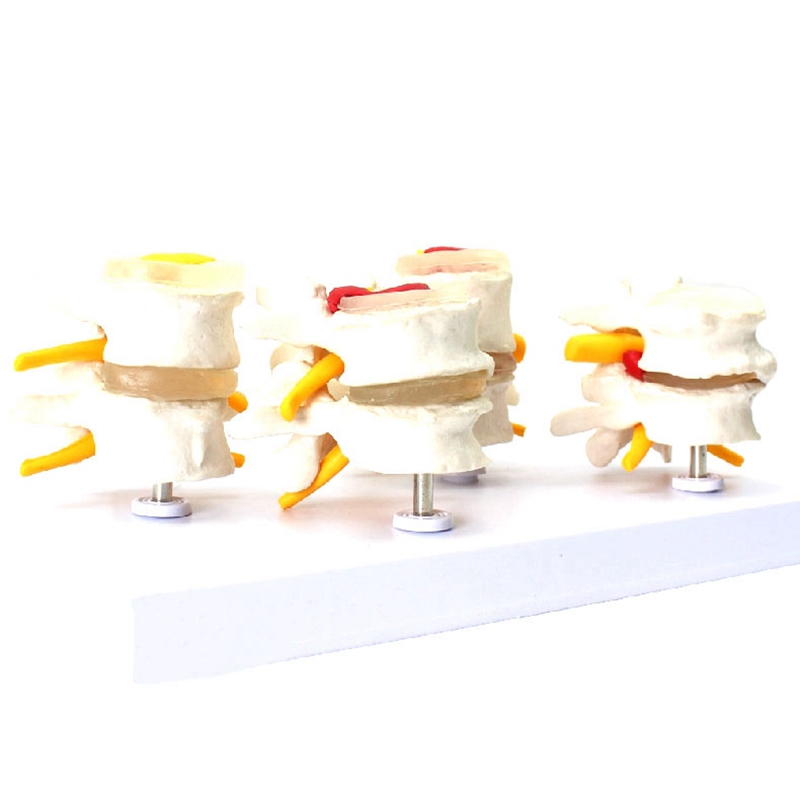 Delicate product Human Anatomy Skeleton Spine 4-Stages Lumbar Vertebral Model Brain Skull Traumatic Teaching Supplies