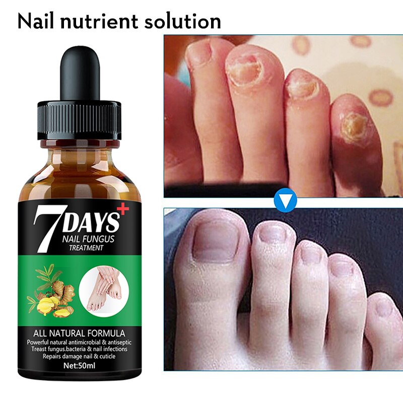 7DAYS Nail Fungus Treatment Essence Serum Care Hand and Foot Care Removal Repair Gel Anti-infective. 