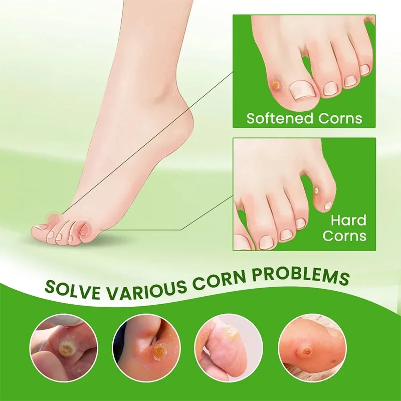 Callus Removal Callus Between 4th And 5th Toe Bunion Buster Bunion