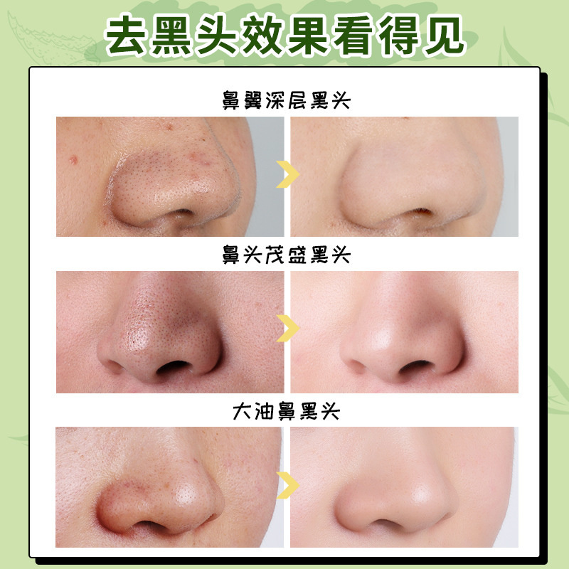 MERCILEN Blackheads Small Green Film Tearing And Pulling Nose Patch Deep Cleansing Oil Control And Shrinking Pore Essence Set. 