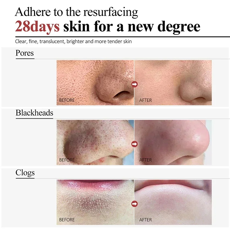 Salicylic Acid Pore Shrinking Cream Quick Eliminate Large Pores Remove Blackehead Tighten Repair Face Smooth Skin Care Products. 