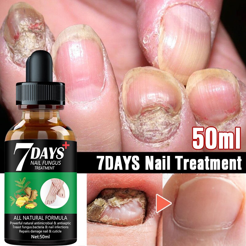 7DAYS Nail Fungus Treatment Essence Serum Care Hand and Foot Care Removal Repair Gel Anti-infective. 