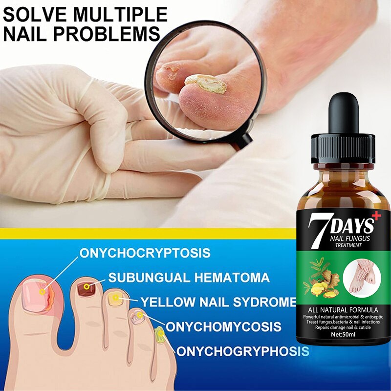 7DAYS Nail Fungus Treatment Essence Serum Care Hand and Foot Care Removal Repair Gel Anti-infective. 