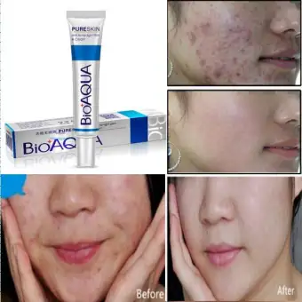 acne rejuvenation cream