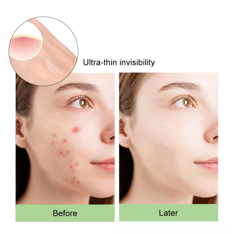 144pcs/box invisible acne patch wart patch remover pimple patch Anti-Acne Spots Marks Concealer Repair Sticker Waterproof. 