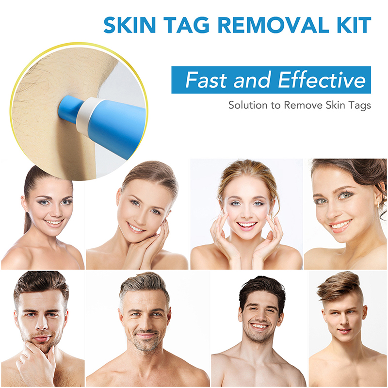 Natural Painless Auto SKIN TAG Removal kit Skin tag bands Remover Device New  Skin Tag Removal. 