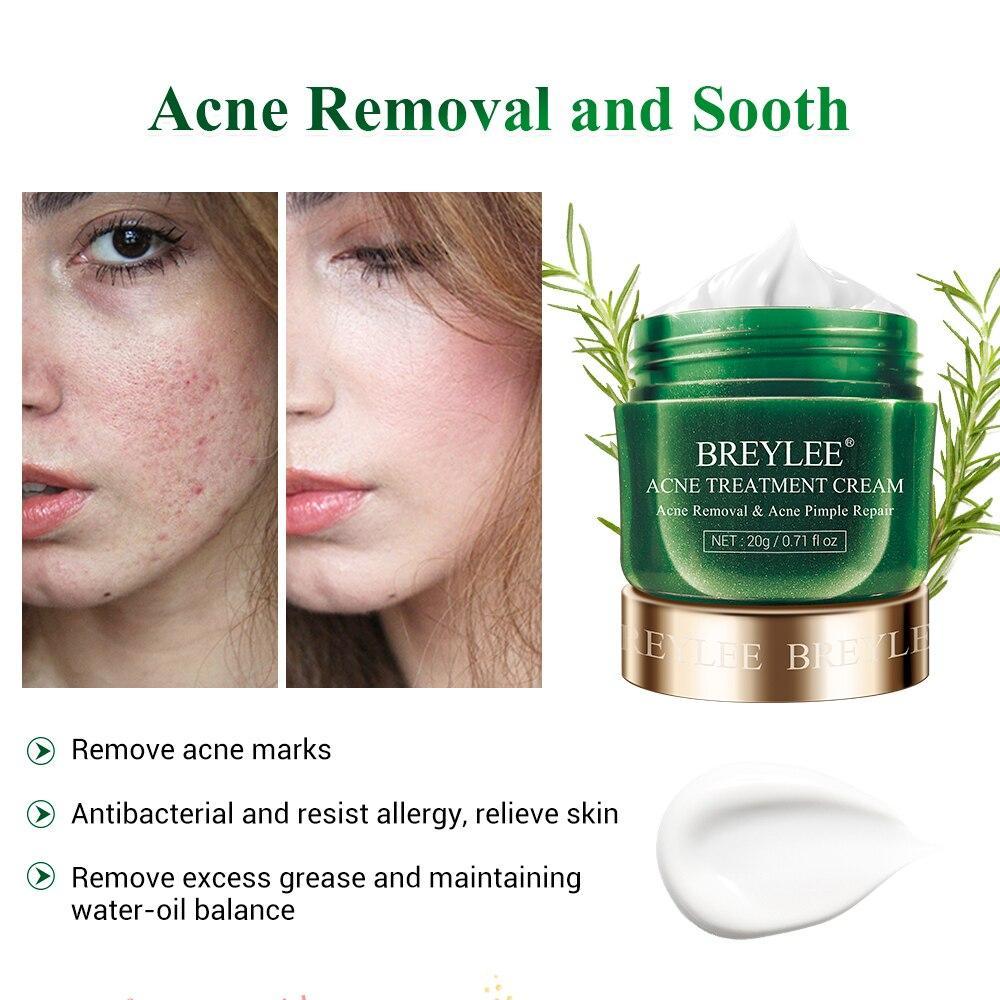 acne control cream