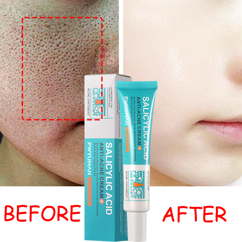 Salicylic Acid Pore Shrinking Cream Quick Eliminate Large Pores Remove Blackehead Tighten Repair Face Smooth Skin Care Products. 