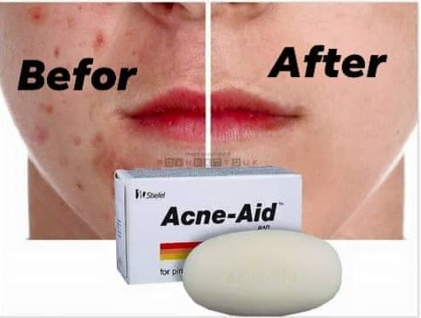STIEFL Acne-Aid Bar -  Pimple Prone & Oily Skin(100gr) Acne Aid Shop. 