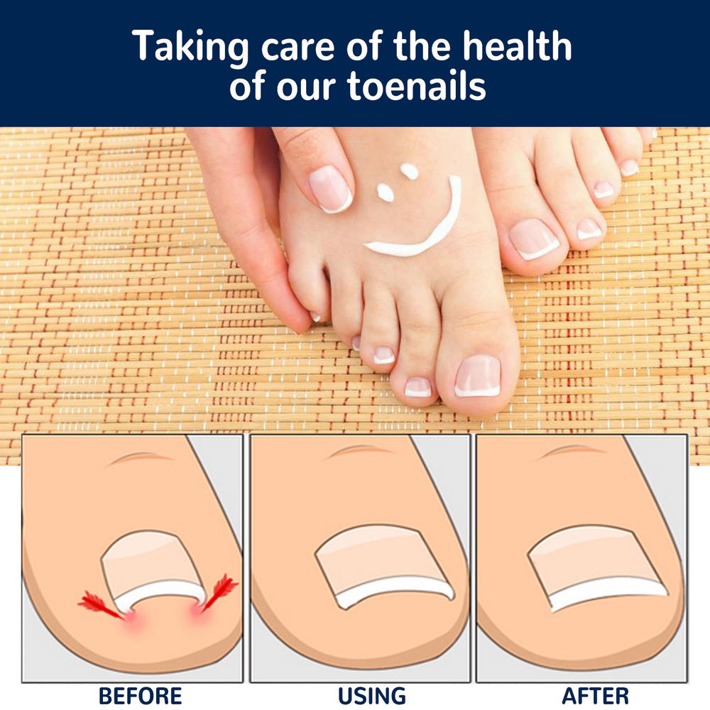 Ingrown Toenail Correction Patch Glue-Free Ingrown Toenail Corrector Strip Painless Pedicure Toenail Corrector Patch With Nail Correction Tool. 