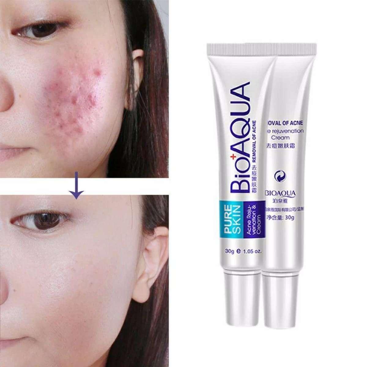 acne removing cream