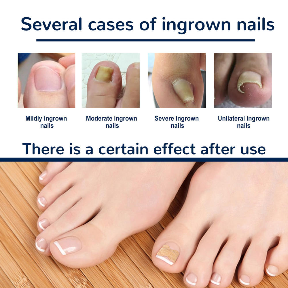 Ingrown Toenail Correction Patch Glue-Free Ingrown Toenail Corrector Strip Painless Pedicure Toenail Corrector Patch With Nail Correction Tool. 