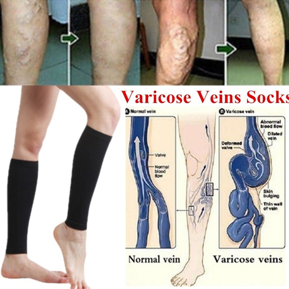 【Xiaofeng】Calf Leg Compression Socks Shin Splint Calf Pain. 