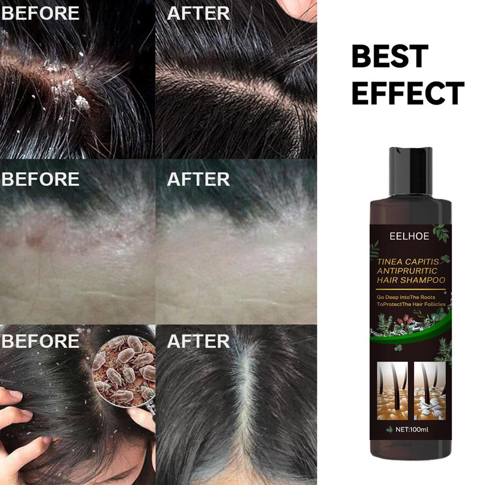 EELHOE 100ml Tinea Dispelling Anti-itching Shampoo Anti-dandruff Shampoo Hair Shampoo Treatment Oil Refreshing Control. 