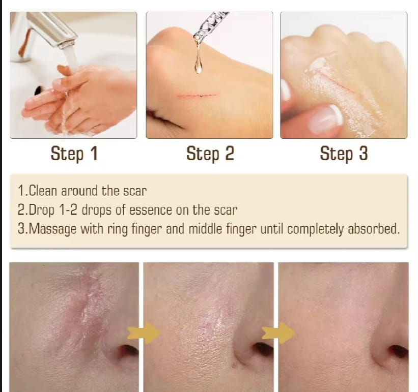 Scar Repair Skin Essential Oil Natural Pure Remove Ance Burn Strentch Marks Scar Removal Skin Therapy Oil Remove Scars Stretch Marks Serum Moisturizing Nourish Improve Rough Smooth Fine Lines Lifting Firming Body Care 30ml. 