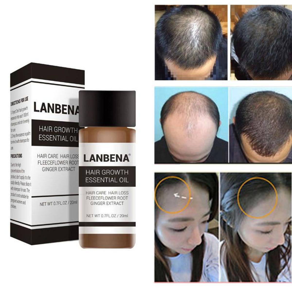 LANBENA Hair Growth Essence Spray Product Preventing Baldness Consolidating Anti Hair Loss Nourish Roots Easy To Carry Hair Care: Buy Online at Best Prices in Bangladesh LANBENA Hair Growth Essence Spray Product Preventing Baldness Consolidating Anti Hair Loss Nourish Roots Easy To Carry Hair Care: Buy Online at Best Prices in Bangladesh