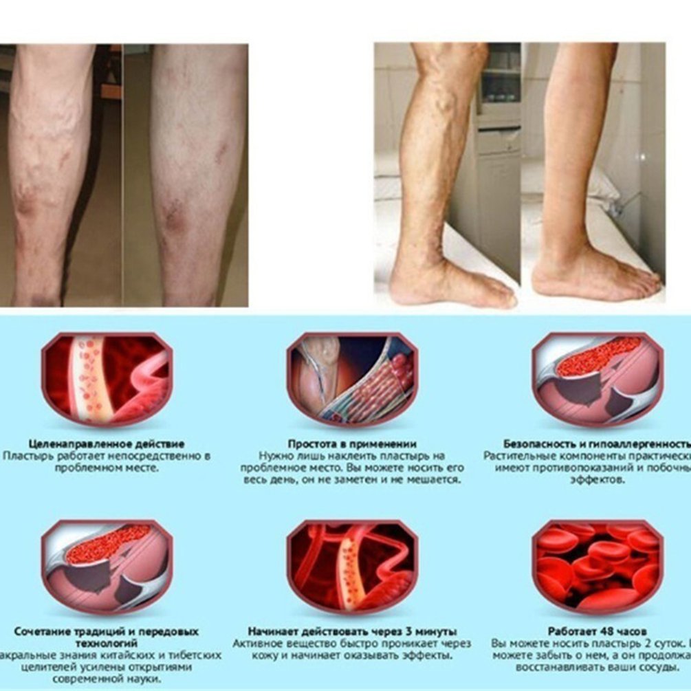 【Xiaofeng】Calf Leg Compression Socks Shin Splint Calf Pain. 