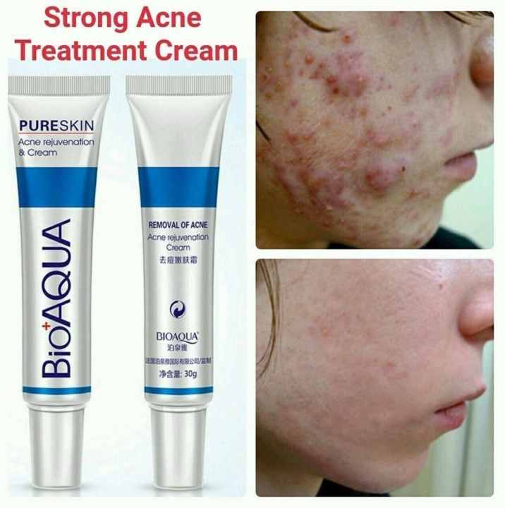 face acne removal cream