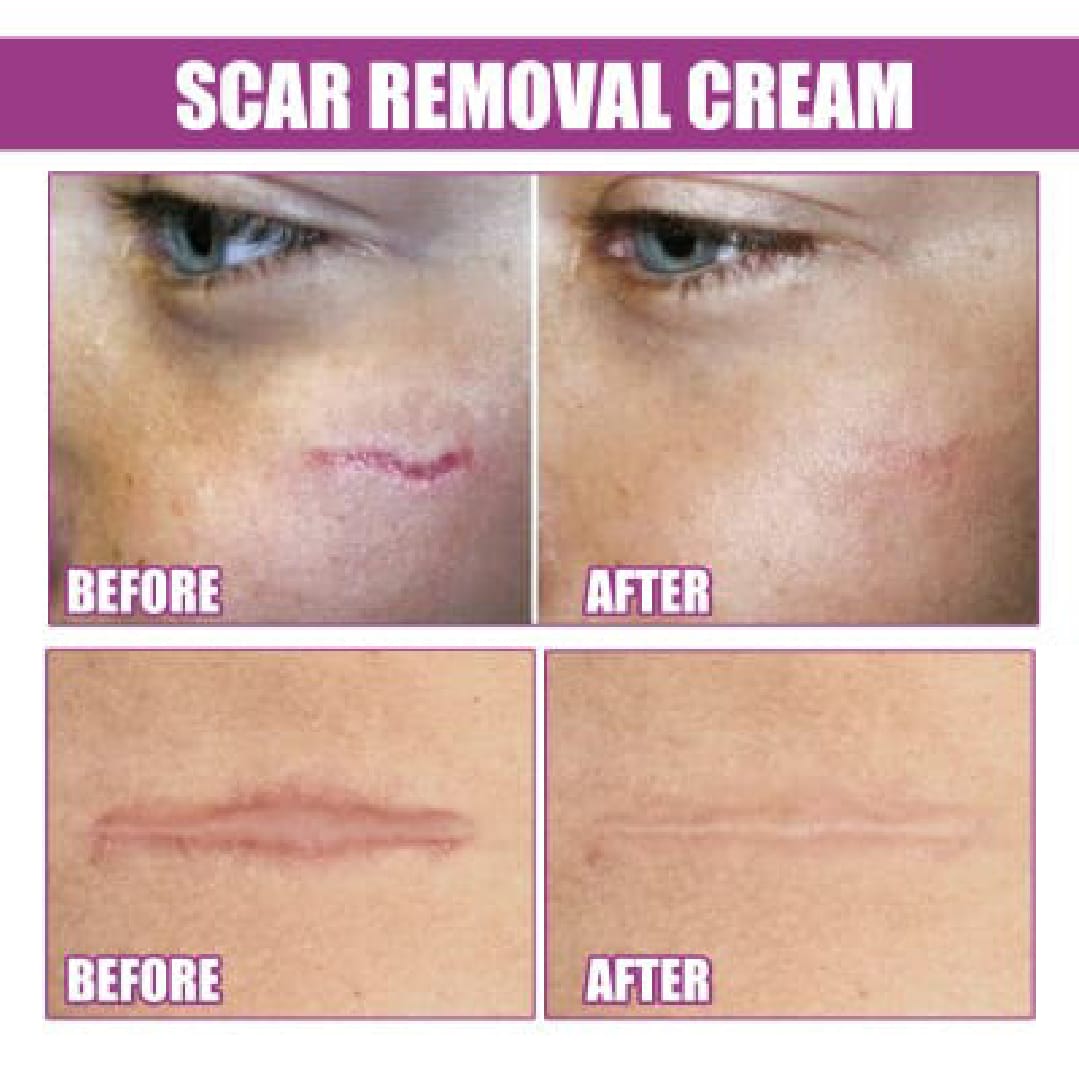 Scar Repair Skin Essential Oil Natural Pure Remove Ance Burn Strentch Marks Scar Removal Skin Therapy Oil Remove Scars Stretch Marks Serum Moisturizing Nourish Improve Rough Smooth Fine Lines Lifting Firming Body Care 30ml. 