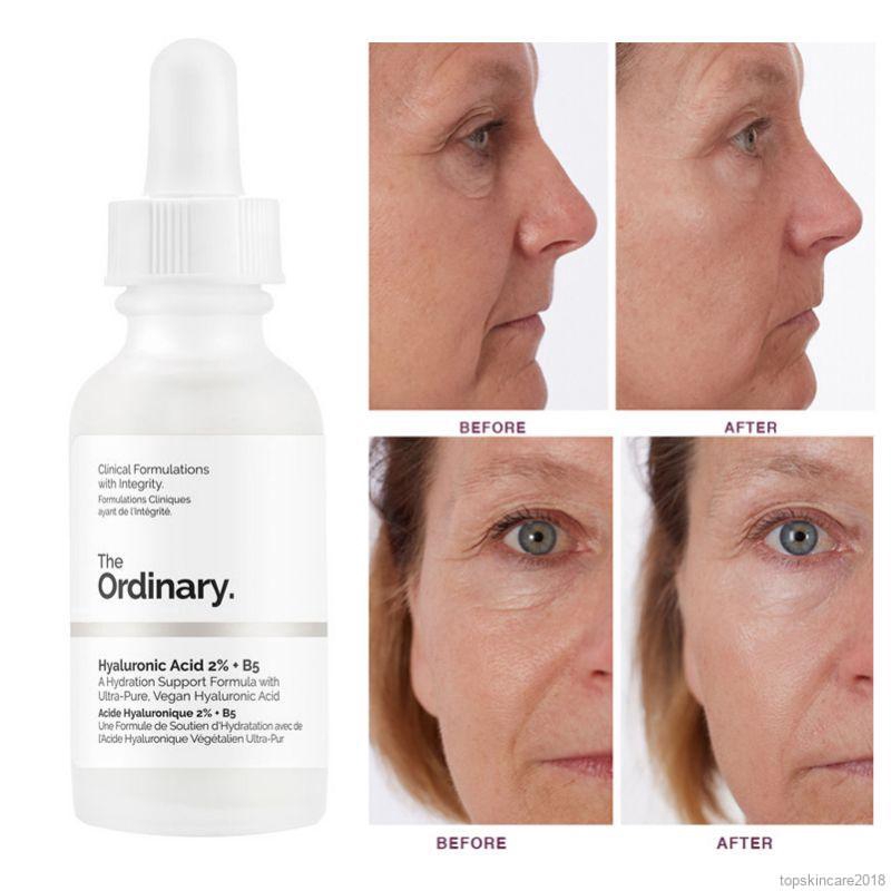 hyaluronic acid ordinary serum