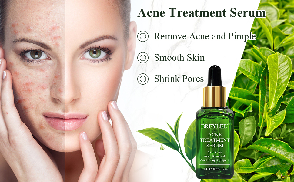 Acne Treatment Serum