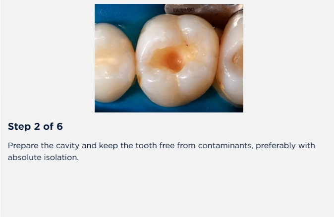 Opallis Flow (FGM Dental) Low Viscosity Composite. Ideal viscosity for use as base of restorations; Easy application.. 