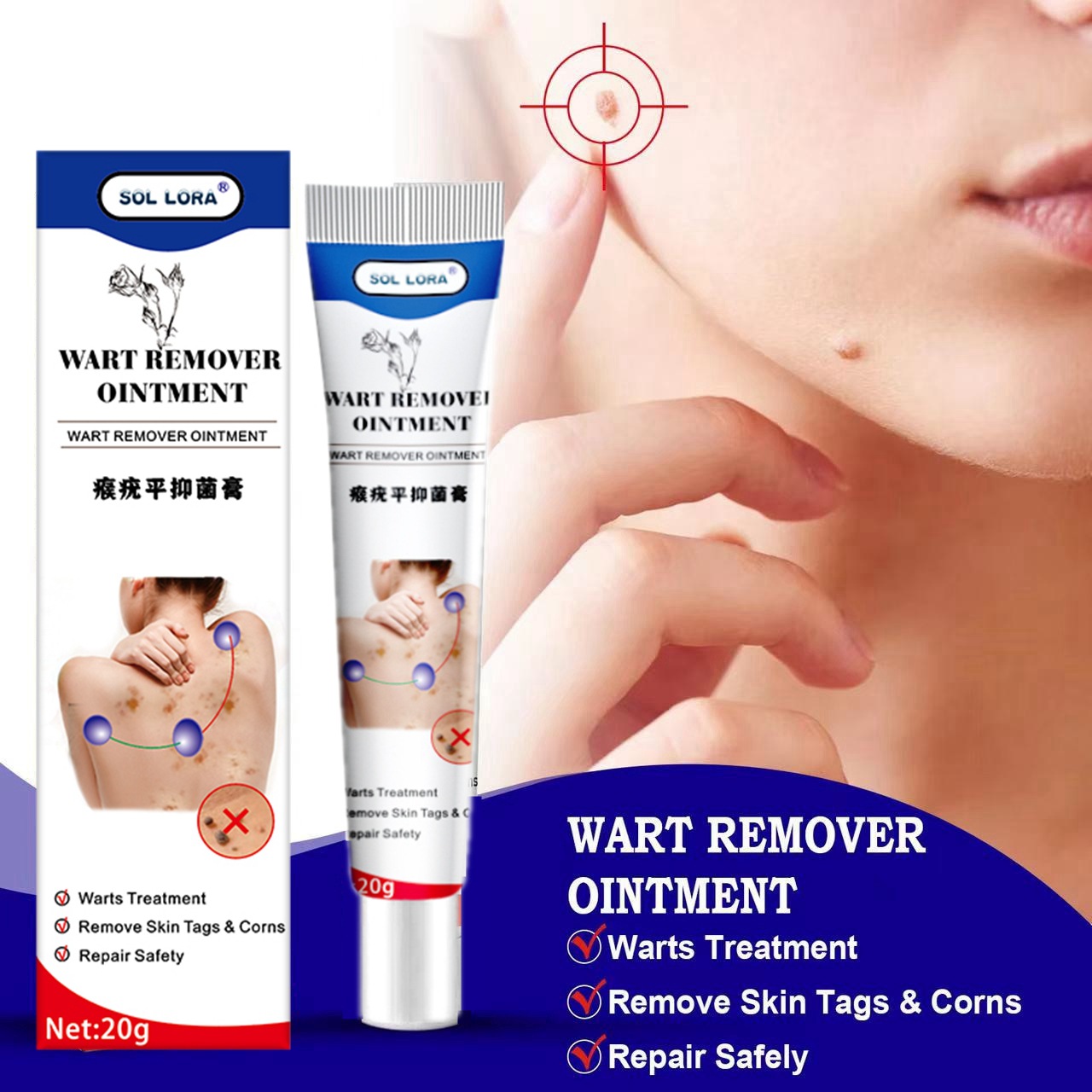 SOL LORA Cross-Border Amazon AliExpress Wart-Removing Cream Wart-Removing Flat Wart-Removing Silk Wart Cream Corns Mole Remover Cream. 