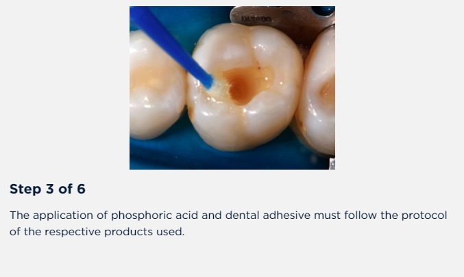 Opallis Flow (FGM Dental) Low Viscosity Composite. Ideal viscosity for use as base of restorations; Easy application.. 