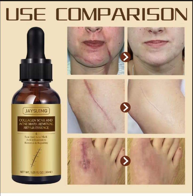 Scar Repair Skin Essential Oil Natural Pure Remove Ance Burn Strentch Marks Scar Removal Skin Therapy Oil Remove Scars Stretch Marks Serum Moisturizing Nourish Improve Rough Smooth Fine Lines Lifting Firming Body Care 30ml