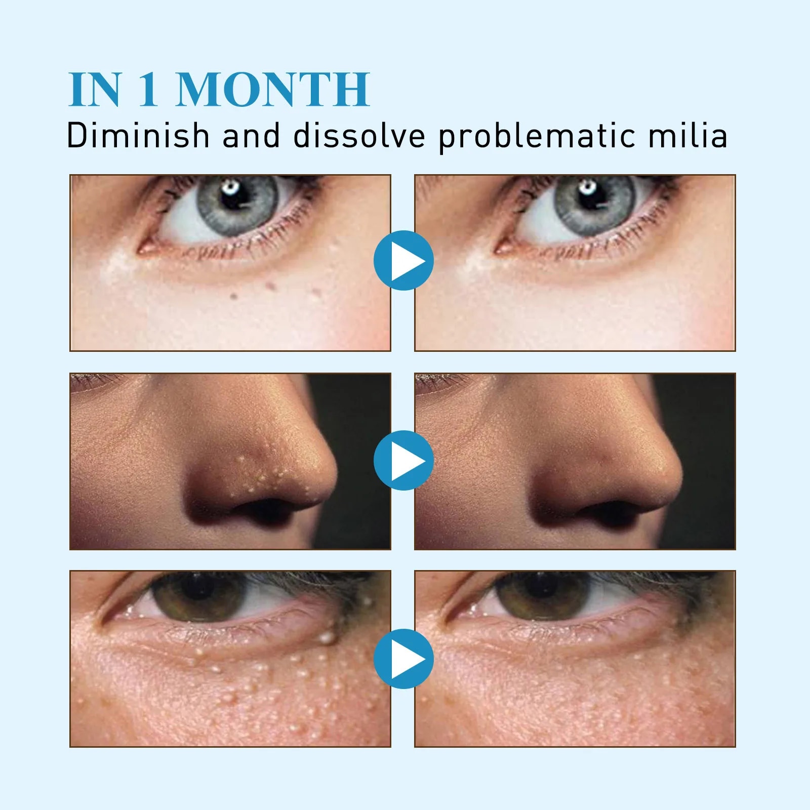 New 144patch/Box Milia Remover Eye Cream Nourishing Moisturizing Repair Smoothing Eye Patches Eyes Pad. 