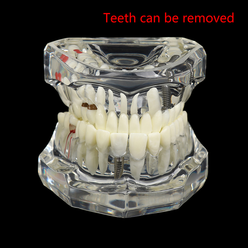 【Atoztide Store】Model Teeth Implant Restoration Bridge Teaching Study Tooth