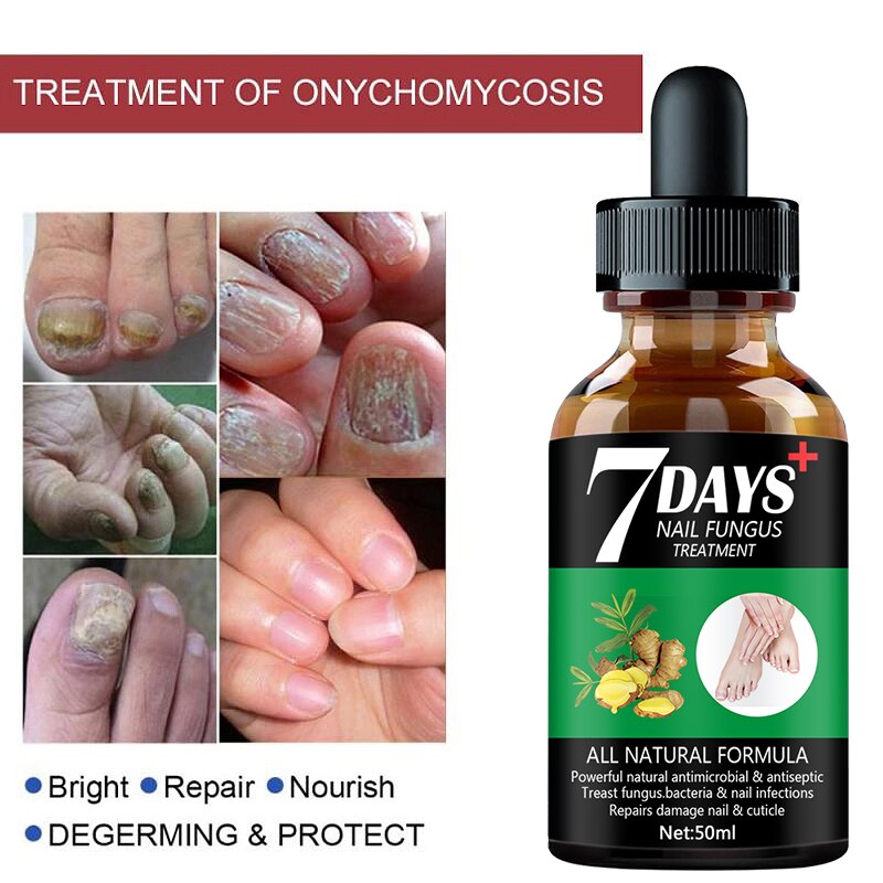 7DAYS Nail Fungus Treatment Essence Serum Care Hand and Foot Care Removal Repair Gel Anti-infective. 