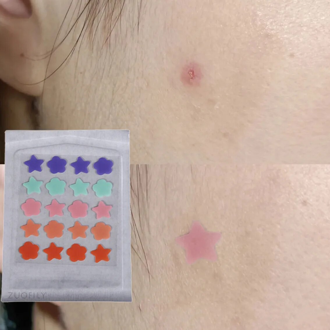 【hot】 Cute Heart Flower Invisible Pimple Patch Face Spot Scar Care Stickers Makeup Concealer Tool Beauty Acne Tools. 