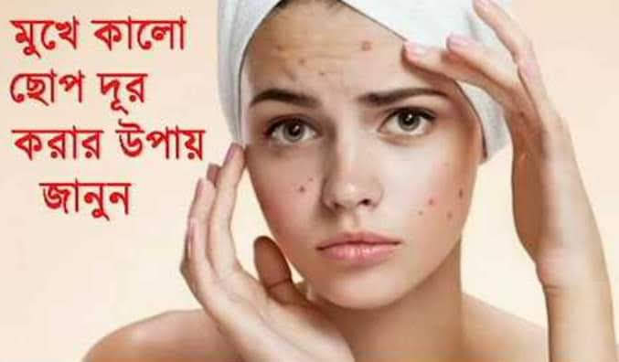 Active Mesta And All Spot Out Cream -15gm & One pcs / Fairness / Brone Out Face Wash Freee. 