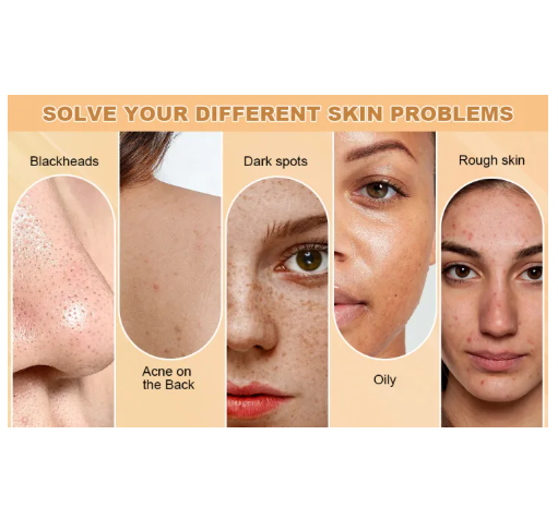 Kojie San Skin Brightening Soap - Original Kojic Soap that Reduces Dark Spots, Hyperpigmentation, & Scars with Coconut & Tea Tree Oil - 65g x 1 Bar. 