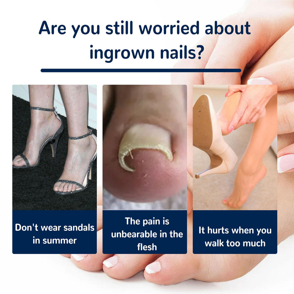 Ingrown Toenail Correction Patch Glue-Free Ingrown Toenail Corrector Strip Painless Pedicure Toenail Corrector Patch With Nail Correction Tool. 