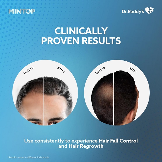 Mintop Minoxidil 5% Hair Restore Formula - 60ml. 