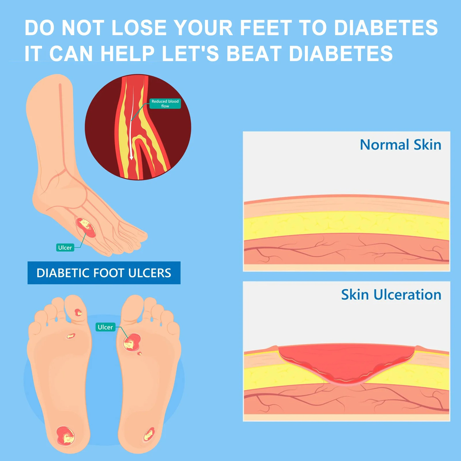 Diabetes Treatment Foot Cream Repair Feet Ulceration Relieve Itchy