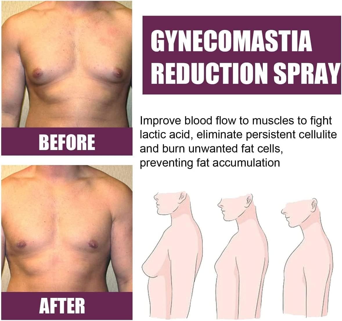Gynecomastia Reduction Spray, Chest Cellulite Burner Spray for Men, Gynecomastia Reduction Cellulite Spray, Chest Fat Reduction for Men,Chest Belly Fat Remove (30Ml). 