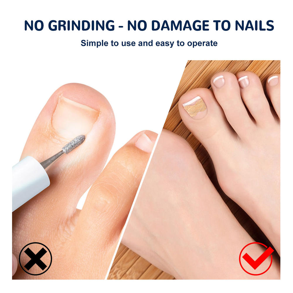 Ingrown Toenail Correction Patch Glue-Free Ingrown Toenail Corrector Strip Painless Pedicure Toenail Corrector Patch With Nail Correction Tool. 