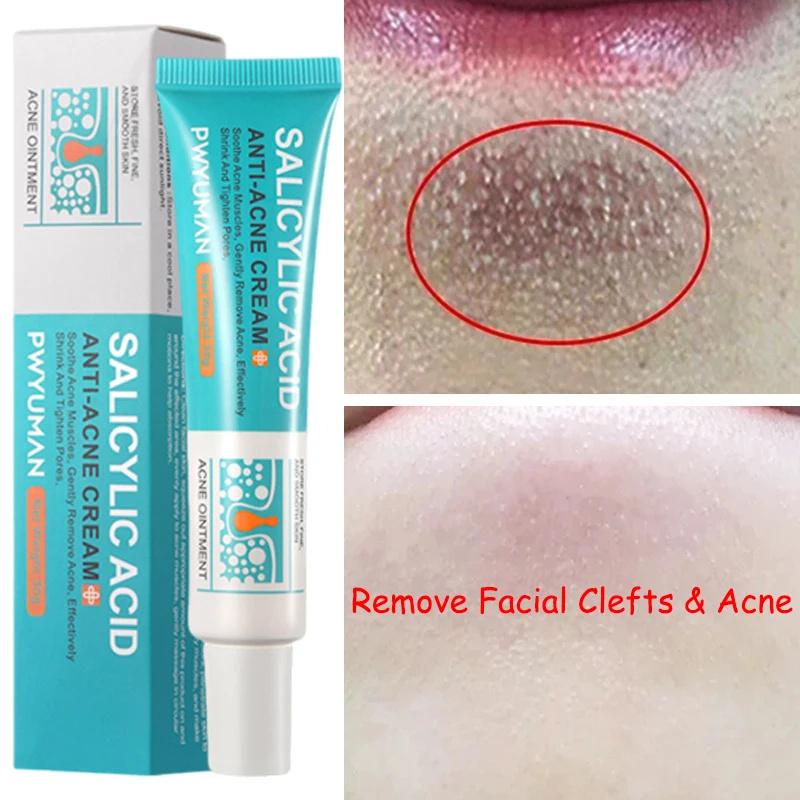 Salicylic Acid Pore Shrinking Cream Quick Eliminate Large Pores Remove Blackehead Tighten Repair Face Smooth Skin Care Products. 