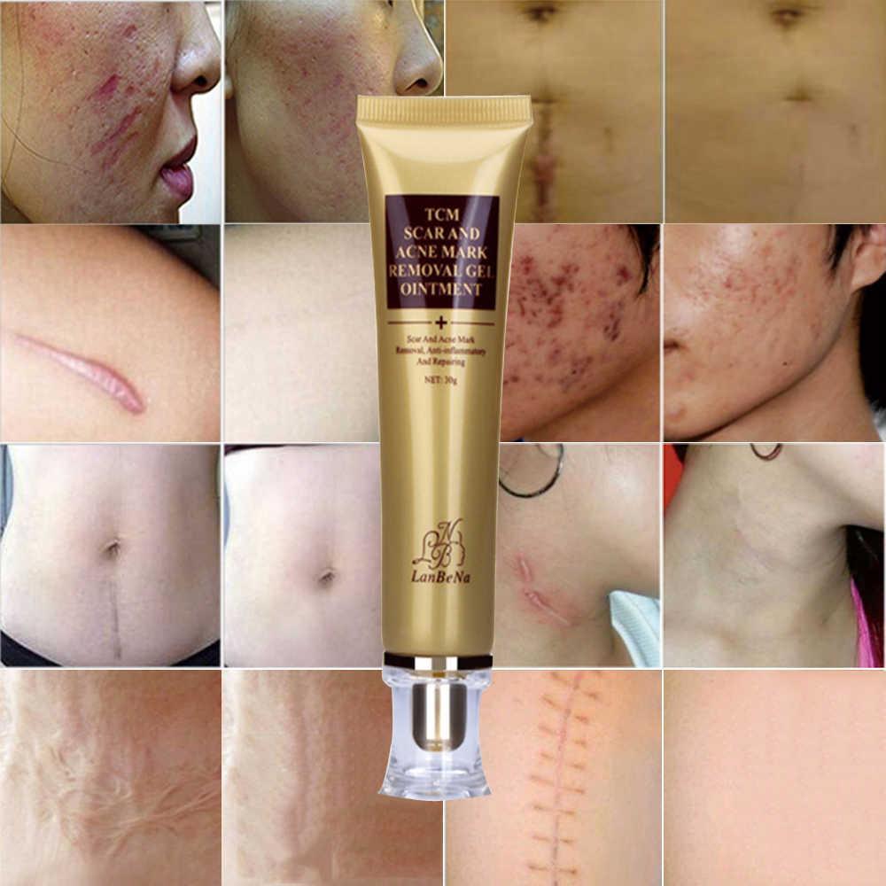 tcm scar and acne mark removal gel ointment price