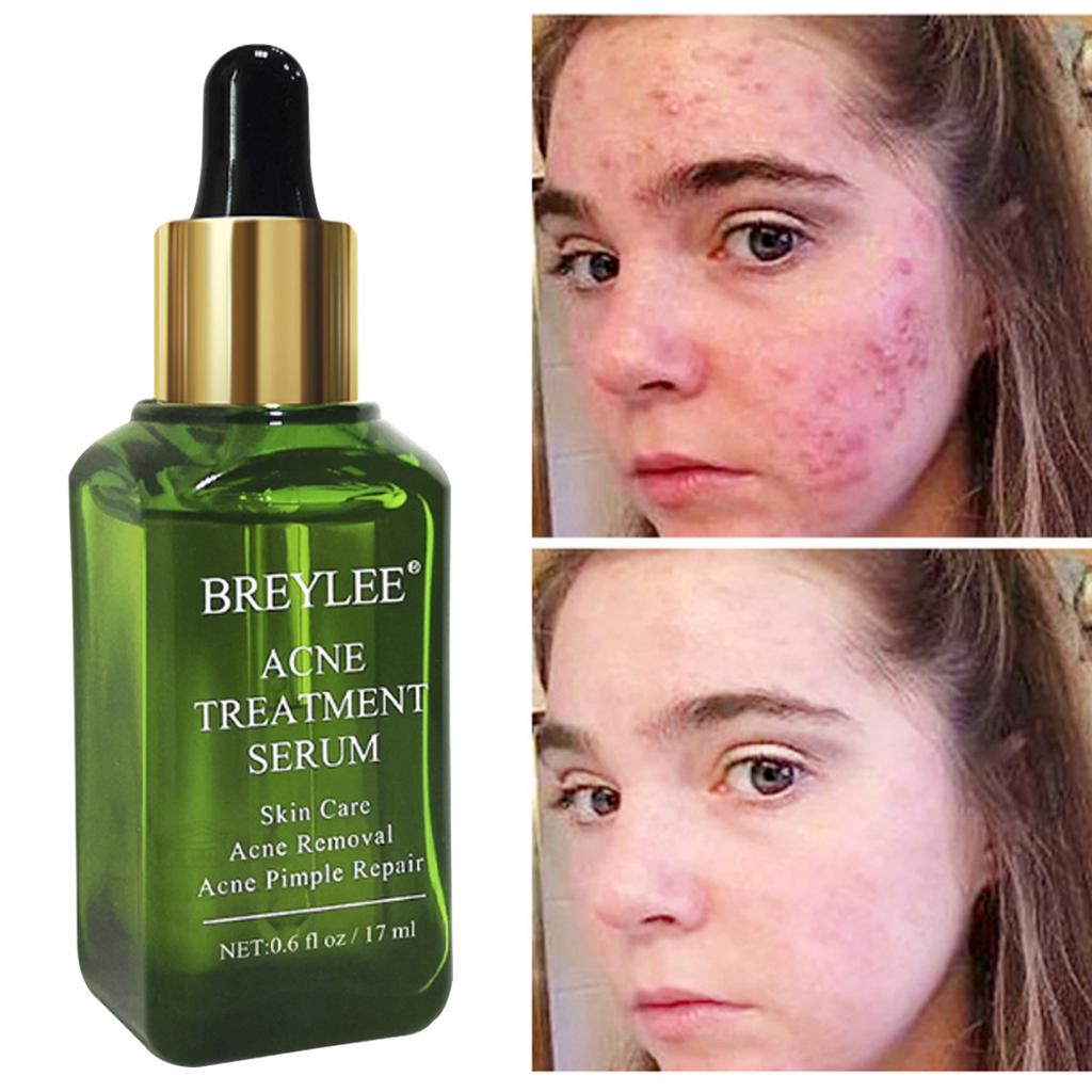 bd serum for acne